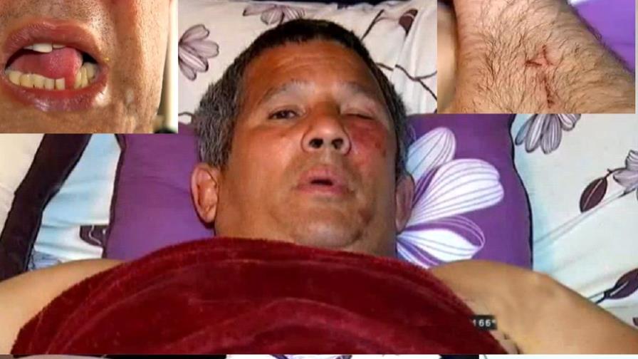 Dominicano en Nueva Jersey denuncia brutalidad policial 