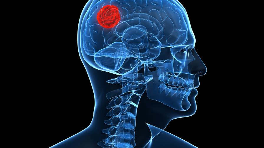 Identifican un mecanismo clave en la formación de tumores cerebrales