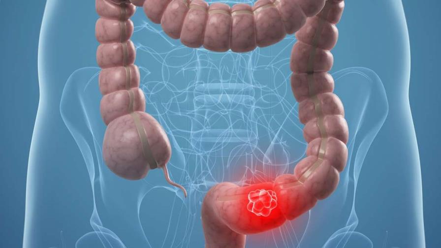 El 90% del cáncer colorectal es curable si se detecta a tiempo El 90% del cáncer colorectal es curable si se detecta a tiempo
