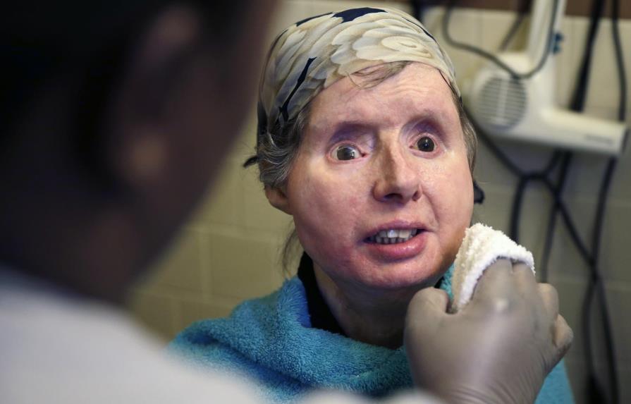 Ingresan por complicaciones a mujer que transplantaron rostro 
