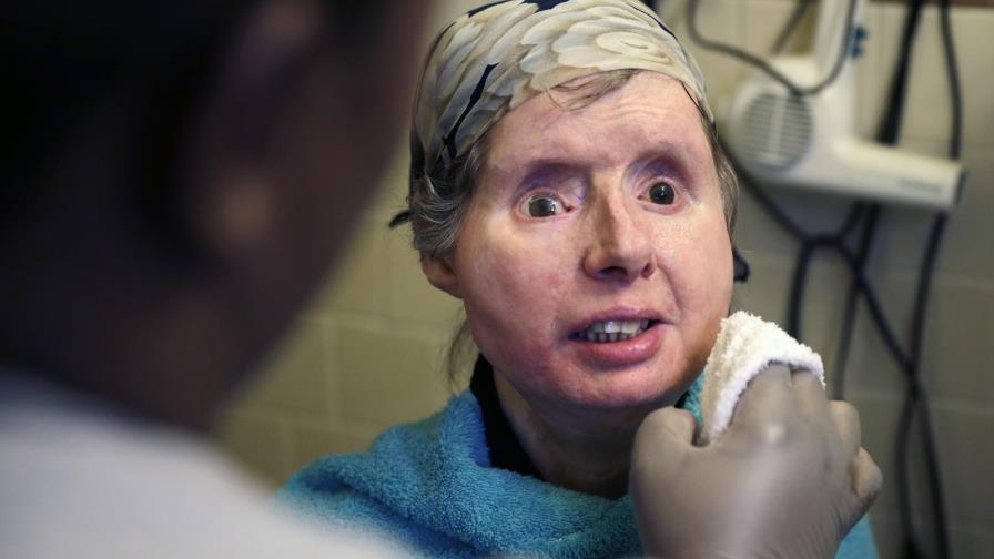 Ingresan por complicaciones a mujer que transplantaron rostro 