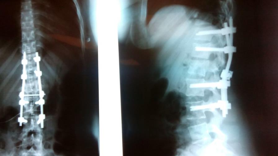 Realizan exitosa cirugía de columna vertebral a víctima de accidente Realizan exitosa cirugía de columna vertebral a víctima de accidente