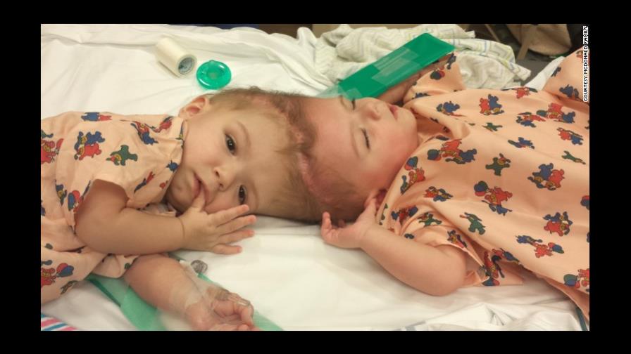 Separan con éxito a dos gemelos unidos por la cabeza en Estados Unidos