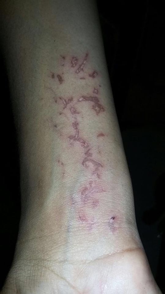 Los golpes que recibió en uno de los brazos la hija de Mireya Mota.