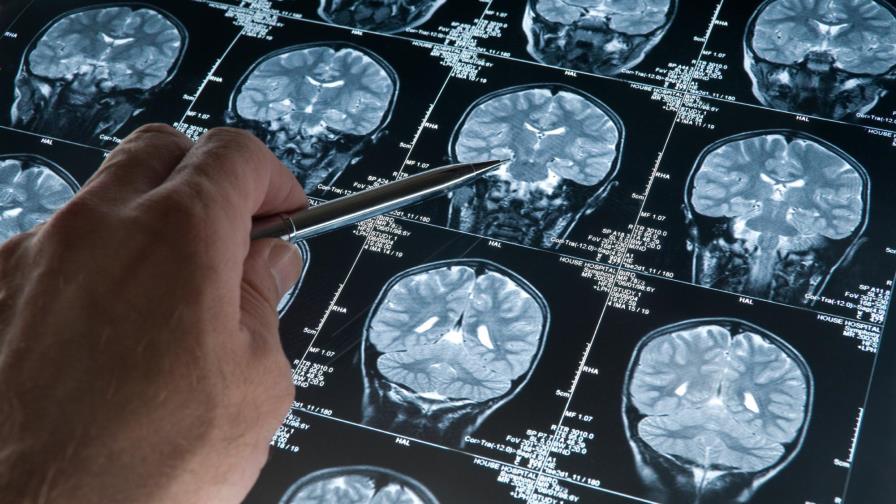 Asocian el Alzheimer con la producción irregular de óxido nítrico en cerebro