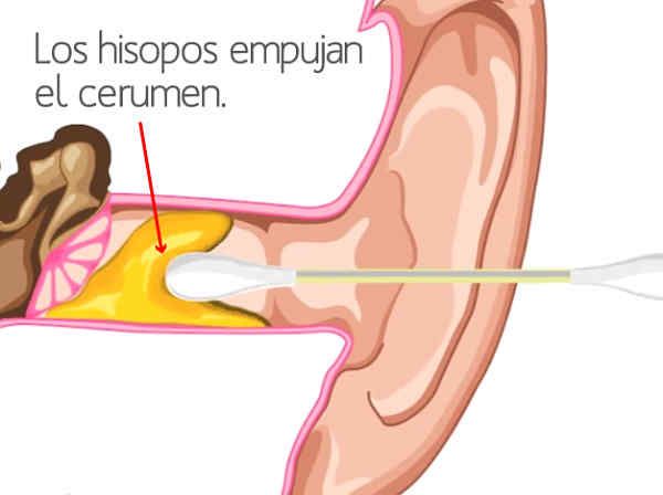 Lo que pasa cuando limpias tus oídos con hisopos - Diario Libre