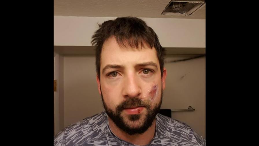 Cigarrillo electrónico explota en la boca de un hombre Cigarrillo electrónico explota en la boca de un hombre