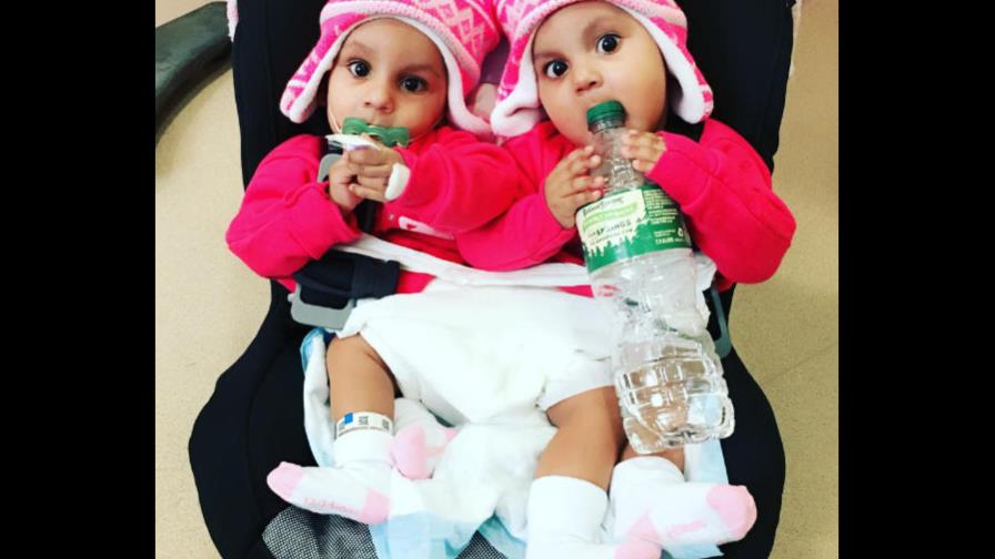 Médicos logran separar siamesas mocanas 