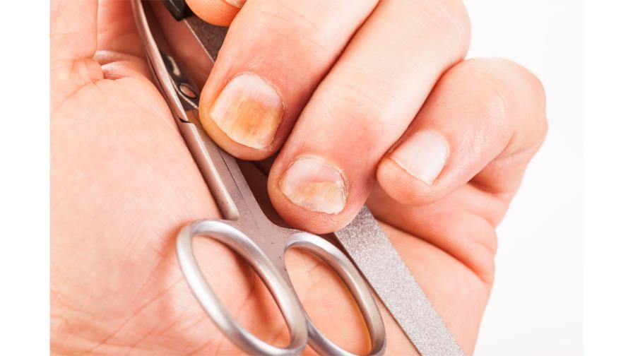 Síndrome de uñas amarillas Síndrome de uñas amarillas