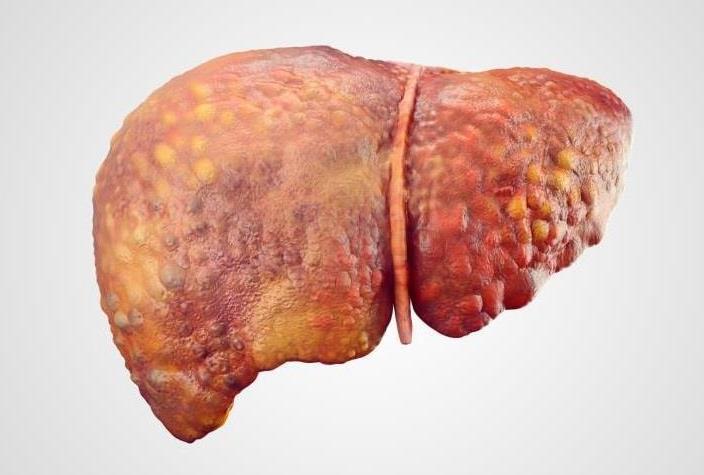 Abren vía para mejorar tratamiento del hígado graso más severo
