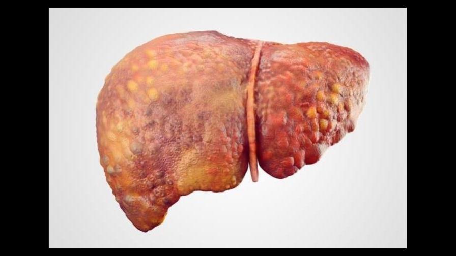 Abren vía para mejorar tratamiento del hígado graso más severo Abren vía para mejorar tratamiento del hígado graso más severo