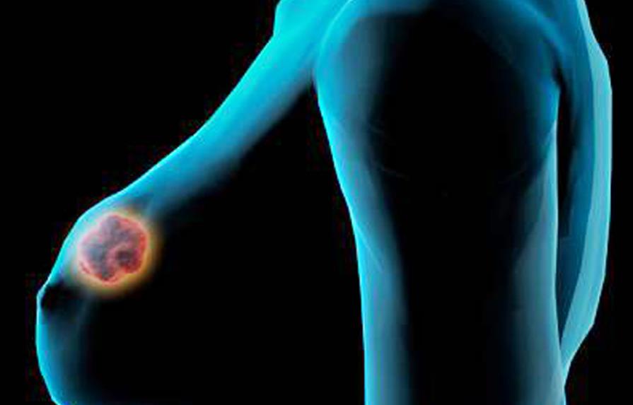 Test podría evitar quimioterapia en un 40% de pacientes con cáncer de mama