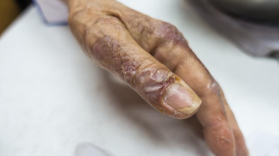 Mujer quema las manos de su hijo porque supuestamente le robó RD$1,200 