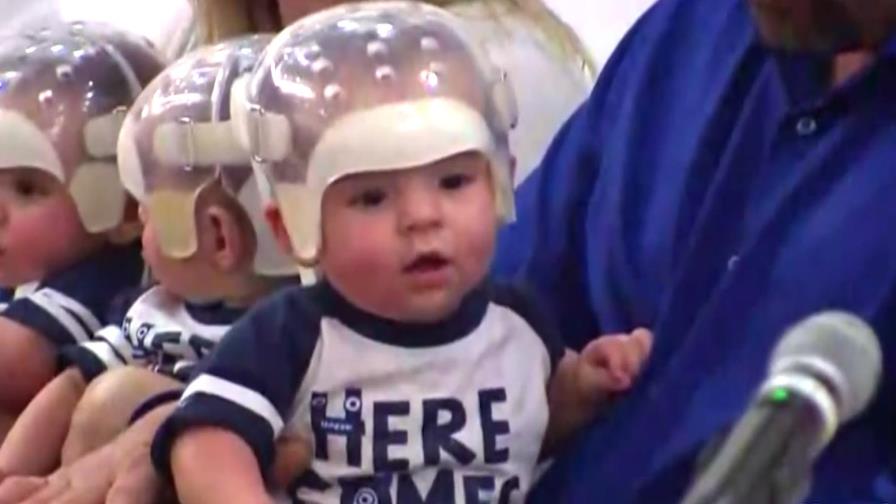 Operan a trillizos con la misma malformación en el cráneo