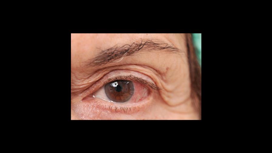 El actual brote de conjuntivitis recuerda la epidemia de los años 80