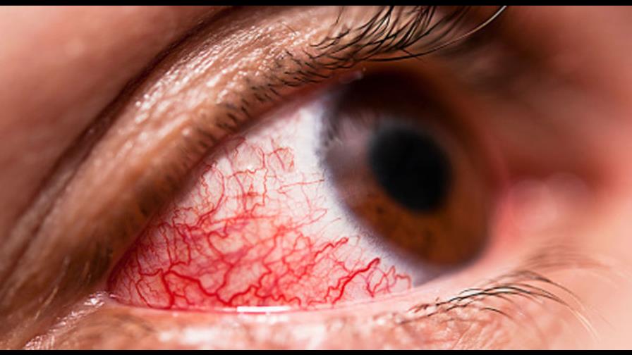 Salud Pública declara epidemia de conjuntivitis Salud Pública declara epidemia de conjuntivitis