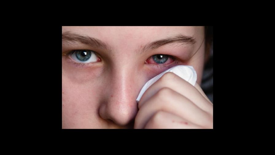 La epidemia de conjuntivitis se apodera de centros hospitalarios en Moca