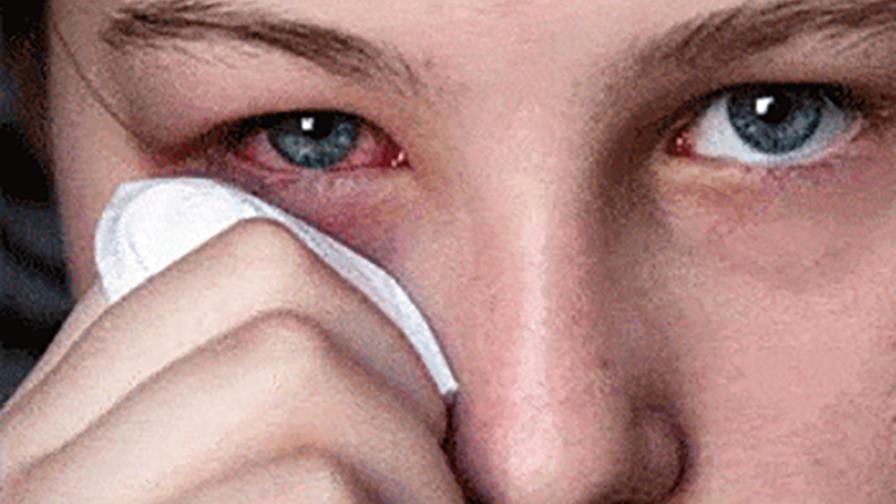 En el país se registran más de 93 mil casos de conjuntivitis en primer semestre
