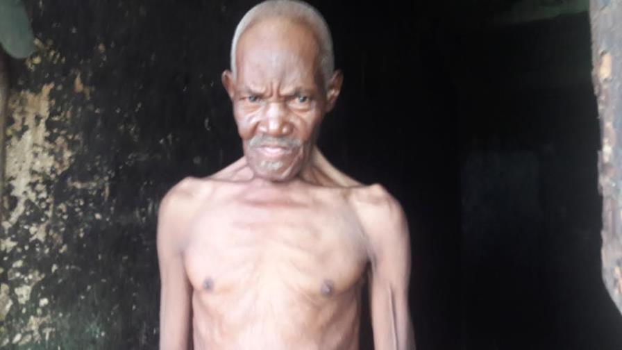 Hombre en la indigencia necesita ayuda para extirparse hernia de 15 libras Hombre en la indigencia necesita ayuda para extirparse hernia de 15 libras