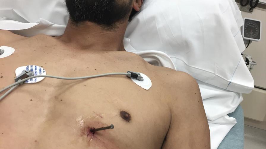 Hombre se salva por poco tras herirse con clavo en el pecho 