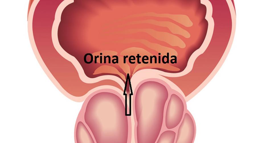 Descubren que extracto de tomate rojo revierte inflamación de la próstata Descubren que extracto de tomate rojo revierte inflamación de la próstata