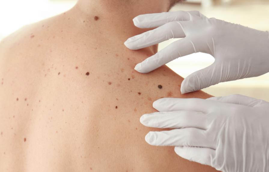 Científicos australianos evitan que el melanoma se propague a otros órganos