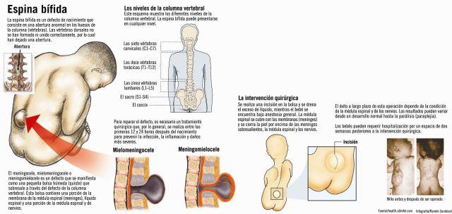 espina bífida oculta rayos x