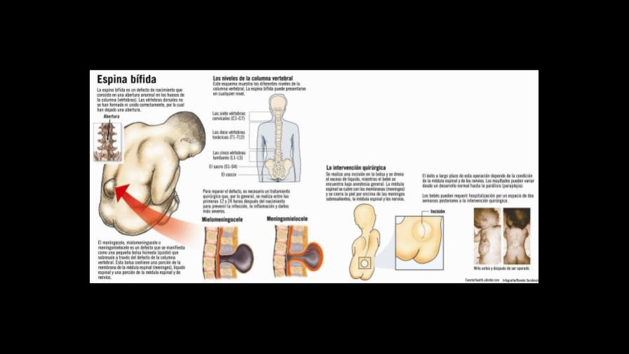 ¿Qué es la espina bífida?