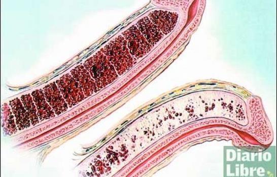 Herencia genética predispone dominicanos al priapismo