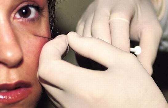 Botox, el borrador de las arrugas