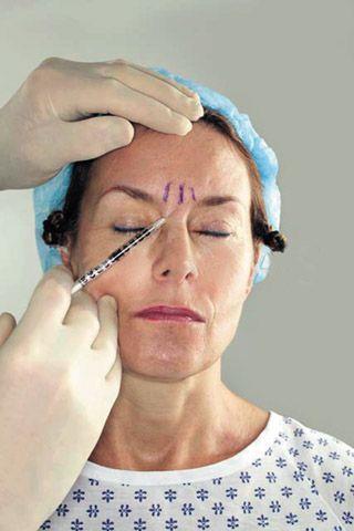 Botox, el borrador de las arrugas