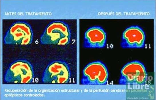Analizan la epilepsia de difícil control y uso nuevos medicamentos