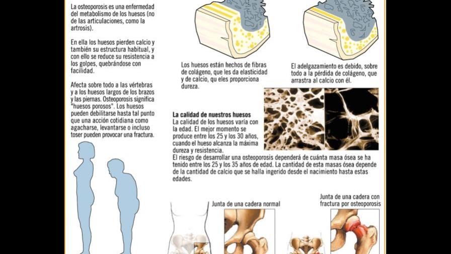 Centro asistirá a pacientes de osteoporosis a bajo costo