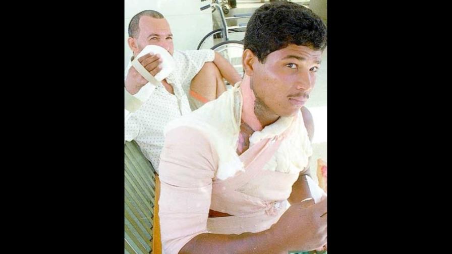 Las quemaduras marcan física y emocionalmente