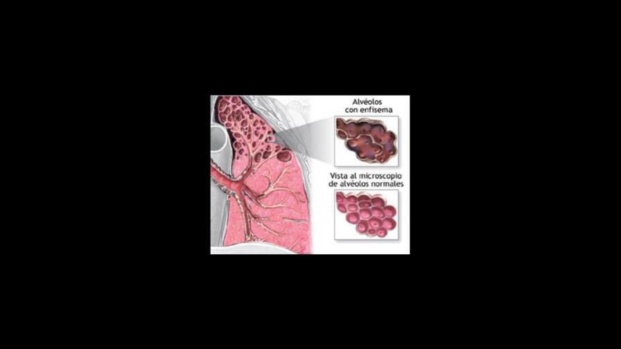 Cirujanos de la Clínica Mayo realizan cirugía de reducción del volumen pulmonar en casos de enfisema