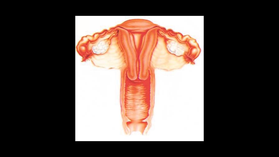 Varias opciones disponibles para diagnosticar y tratar tumores uterinos fibrosos Varias opciones disponibles para diagnosticar y tratar tumores uterinos fibrosos