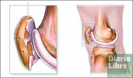 Pacientes recuperan la movilidad con reemplazos