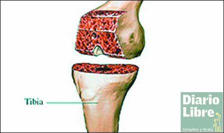 Pacientes recuperan la movilidad con reemplazos
