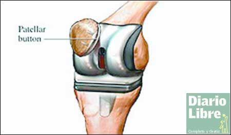 Pacientes recuperan la movilidad con reemplazos