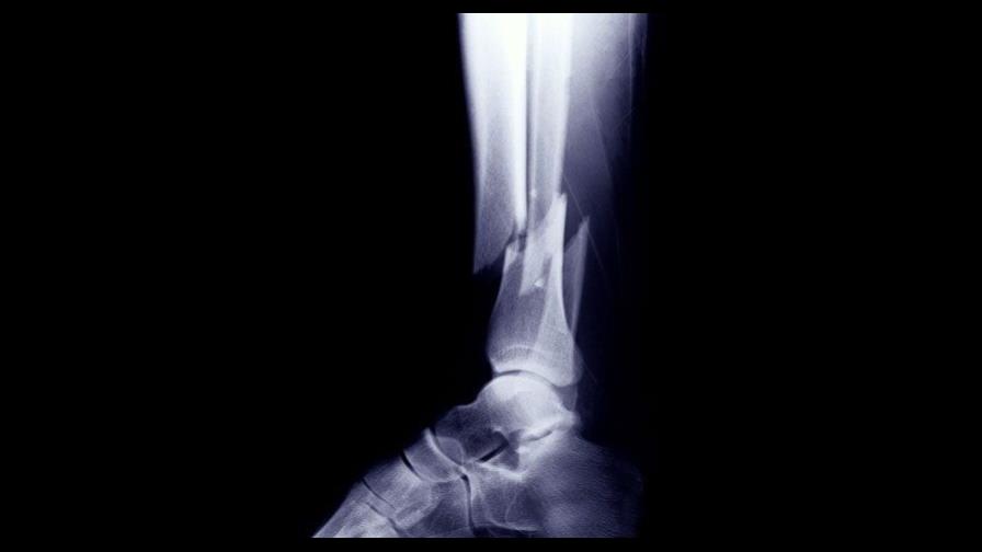 Fracturas, dislocaciones, torceduras y forzaduras (I)