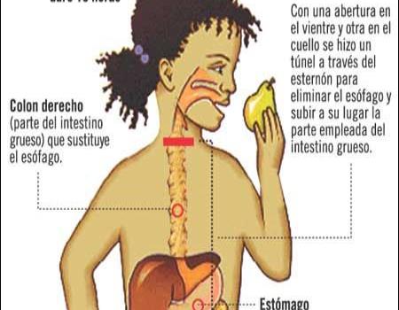 Reconstruyen esófago con parte del intestino grueso Reconstruyen esófago con parte del intestino grueso