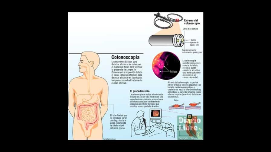 Colonoscopía a tiempo previene el cáncer