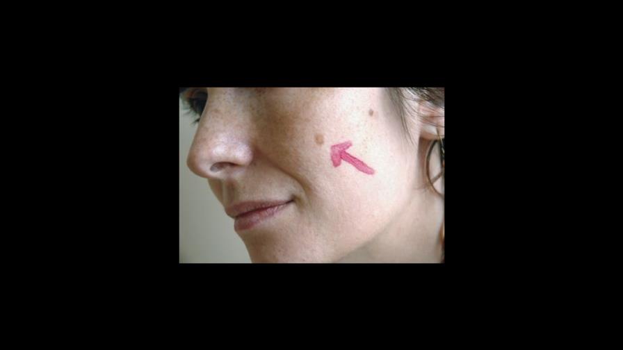 ¿Qué es una verruga solar?