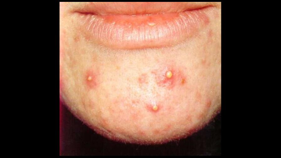 Los chicos con granos son más inseguros y tienen baja autoestima