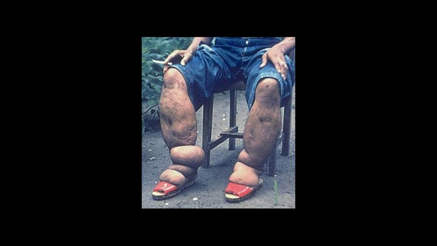 Dos mil personas tienen Filariasis en RD Dos mil personas tienen Filariasis en RD