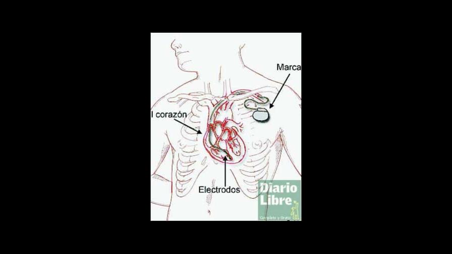 22% de implantes cardíacos causan cuadros infecciosos