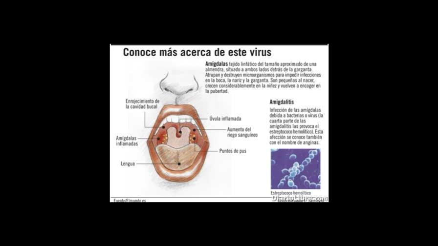 Amigdalitis: Una inflación con múltiples síntomas Amigdalitis: Una inflación con múltiples síntomas