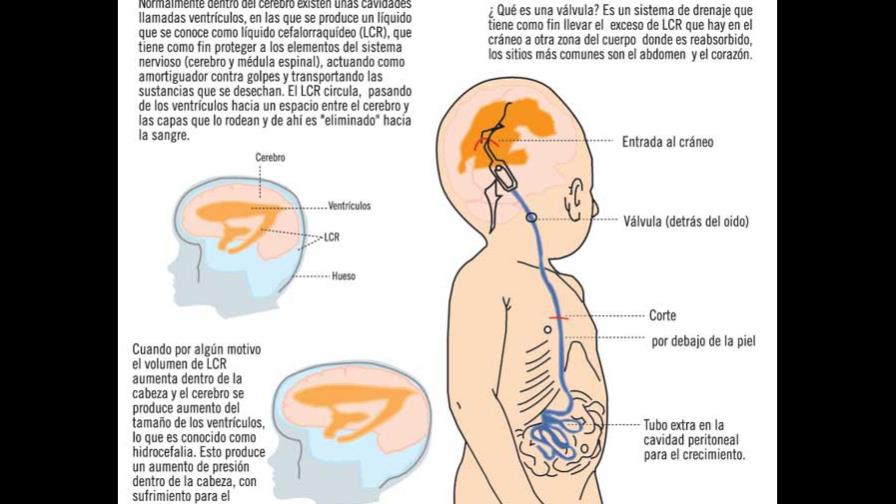 Aprenda sobre hidrocefalia y los métodos para evitarla