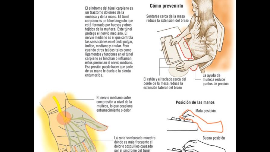 Síndrome del túnel carpiano: una dolencia que puede evitar