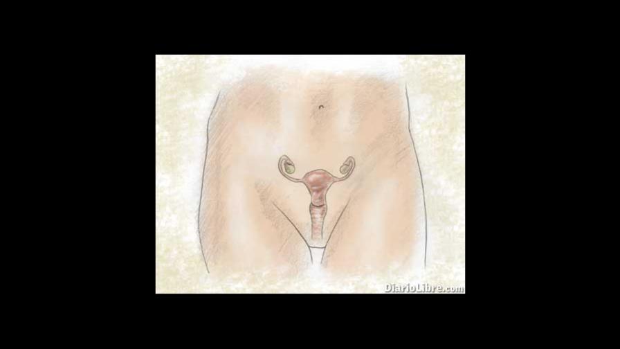 Conoce más acerca del Síndrome de Ovario Poliquístico